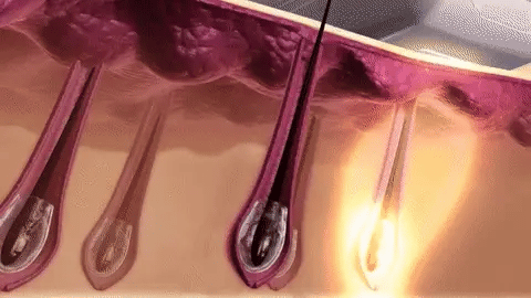 Depiladora Laser Venus™ (Promoción Exclusiva)