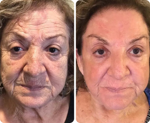 Yolanda Estela — antes y después