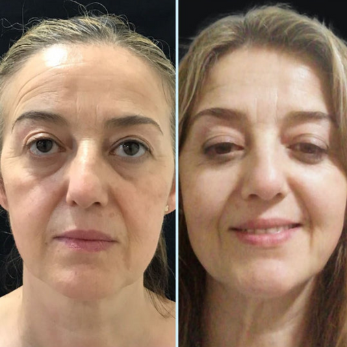 Elena Pérez — antes y después