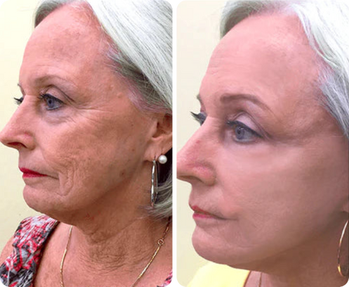 Carmen Rosa — antes y después